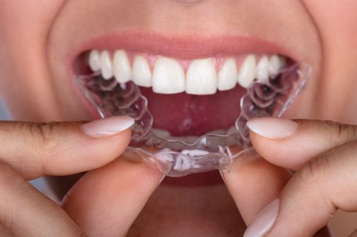 Keep Invisalign Looking Pristine Clearwater FL Dentist